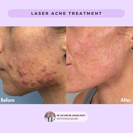 Acne laser treatment results