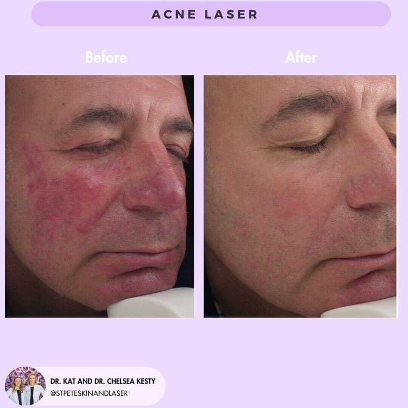 Before and after acne treatment