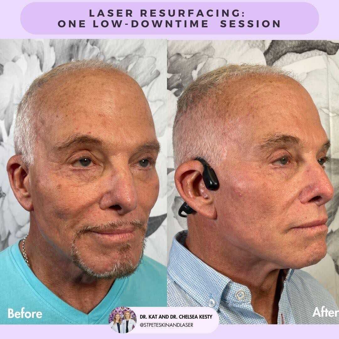 Anti-aging laser treatment results