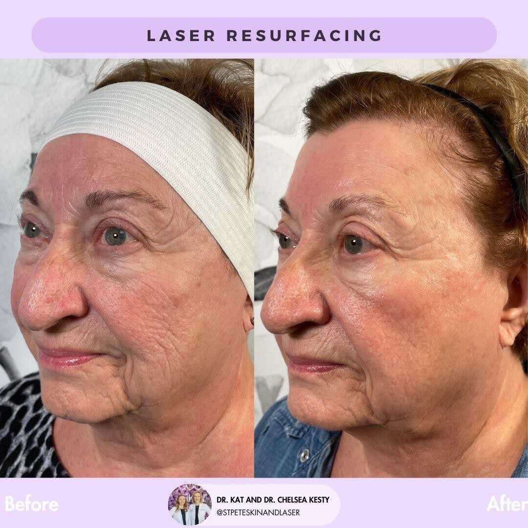Before and after anti-aging treatment