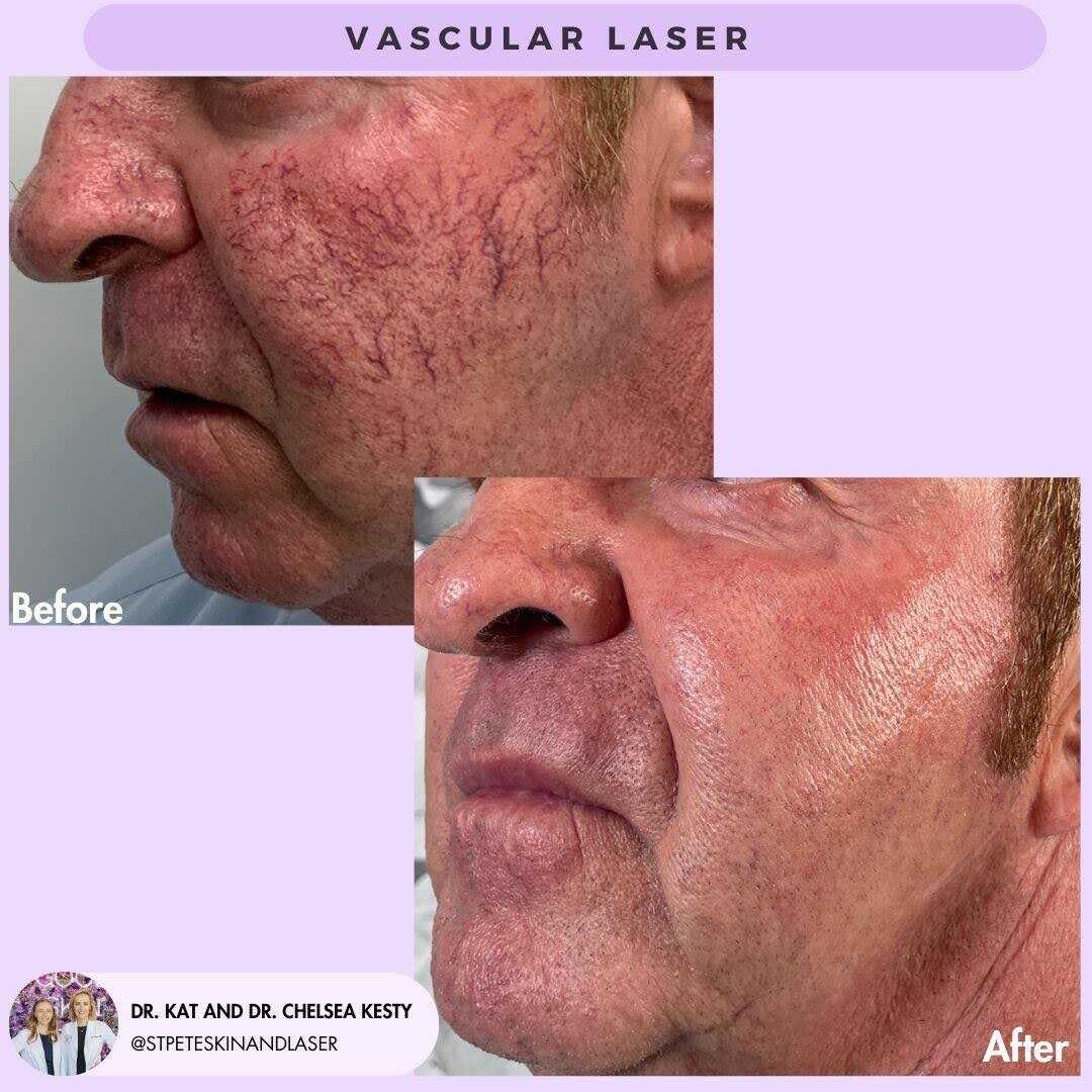 Spider veins laser treatment results