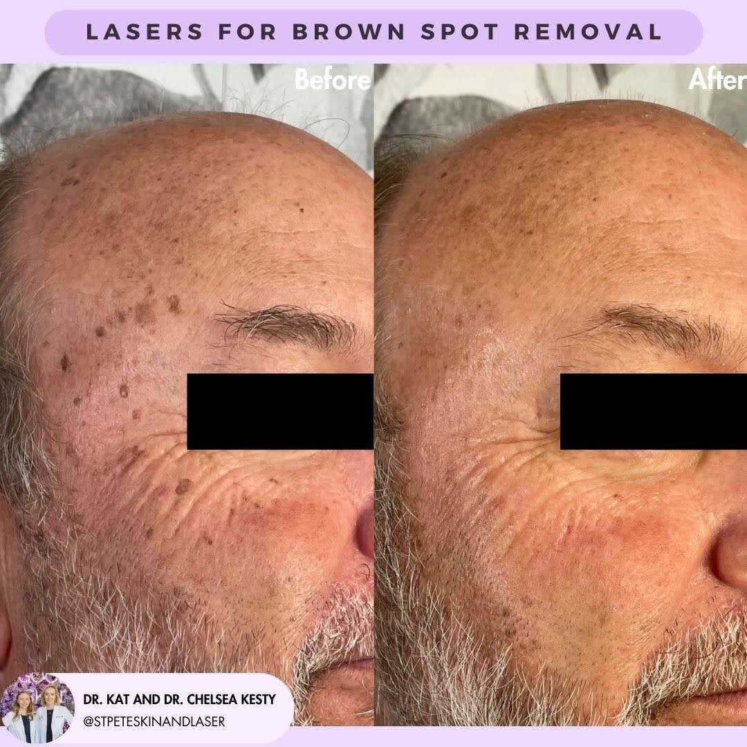 Dark spots treatment before and after results