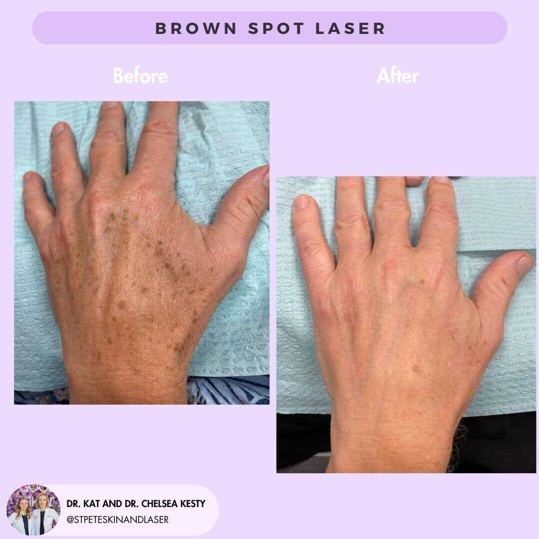 Age spots laser treatment results