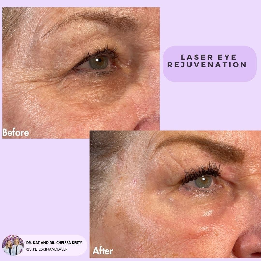 Eye rejuvenation before and after results