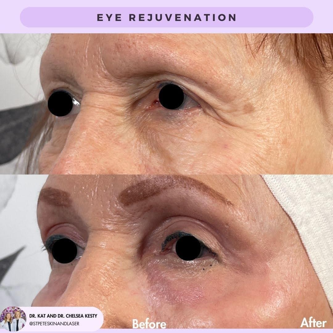 Laser eye treatment results