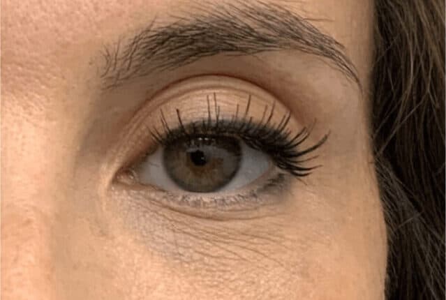 Eye rejuvenation before treatment