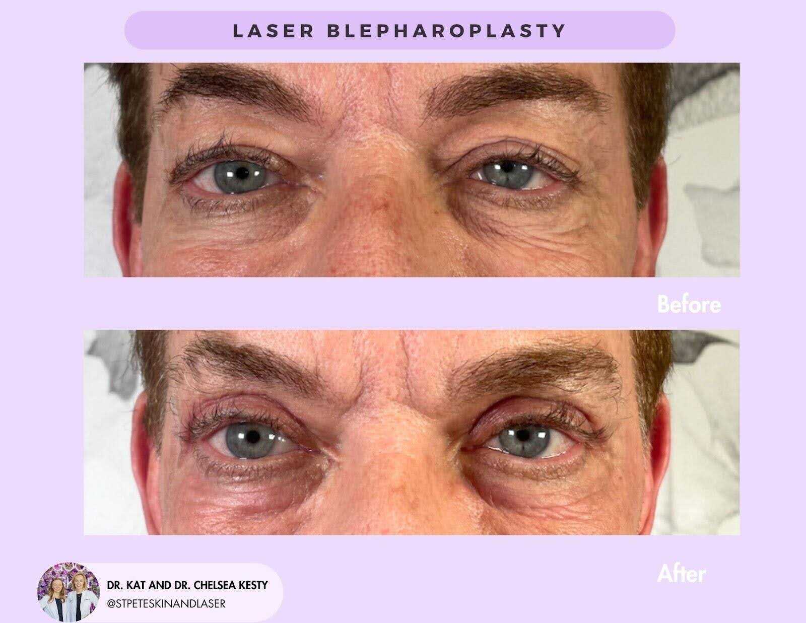 Laser blepharoplasty before treatment