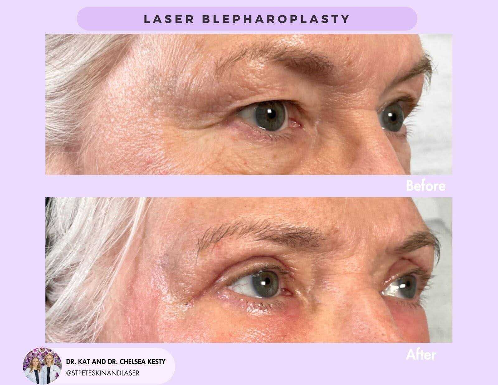 Laser blepharoplasty after treatment