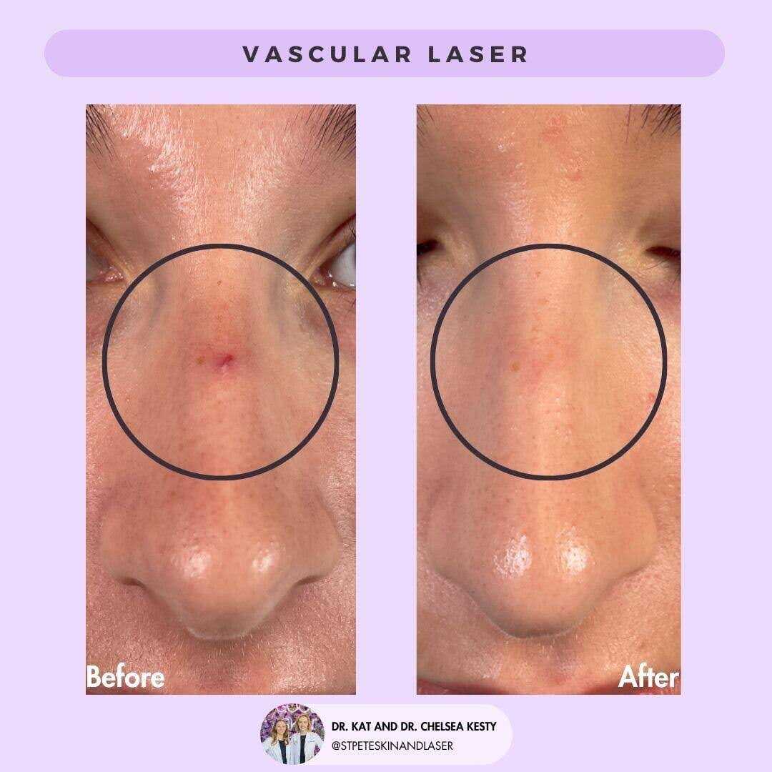 Red spots and cherry angiomas before and after results