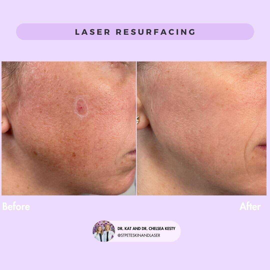 Cherry angioma laser treatment results