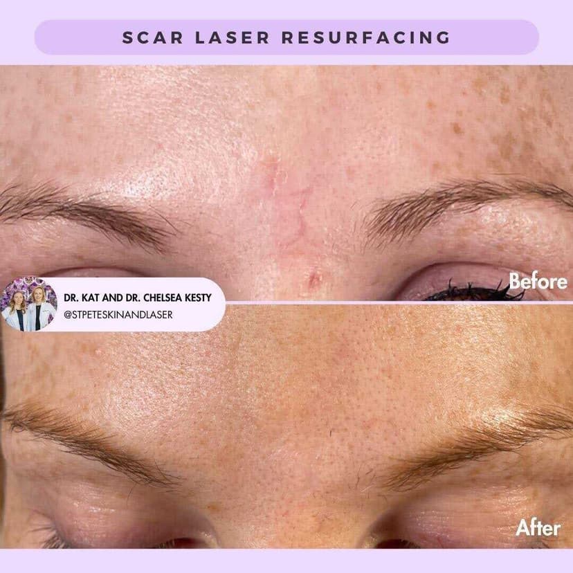 Scar treatment results - before and after