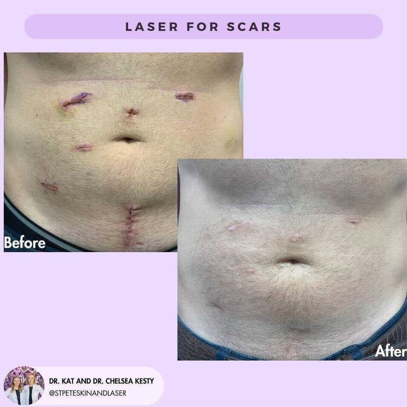 Laser scar treatment results