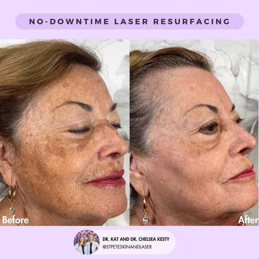Sun damage laser treatment before and after results