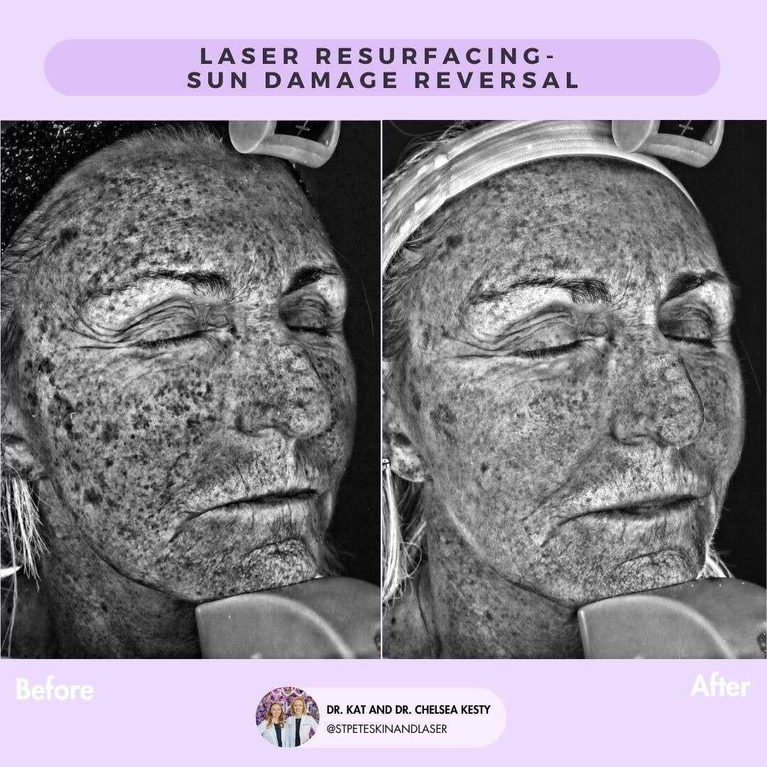 Laser treatment for sun damaged skin results