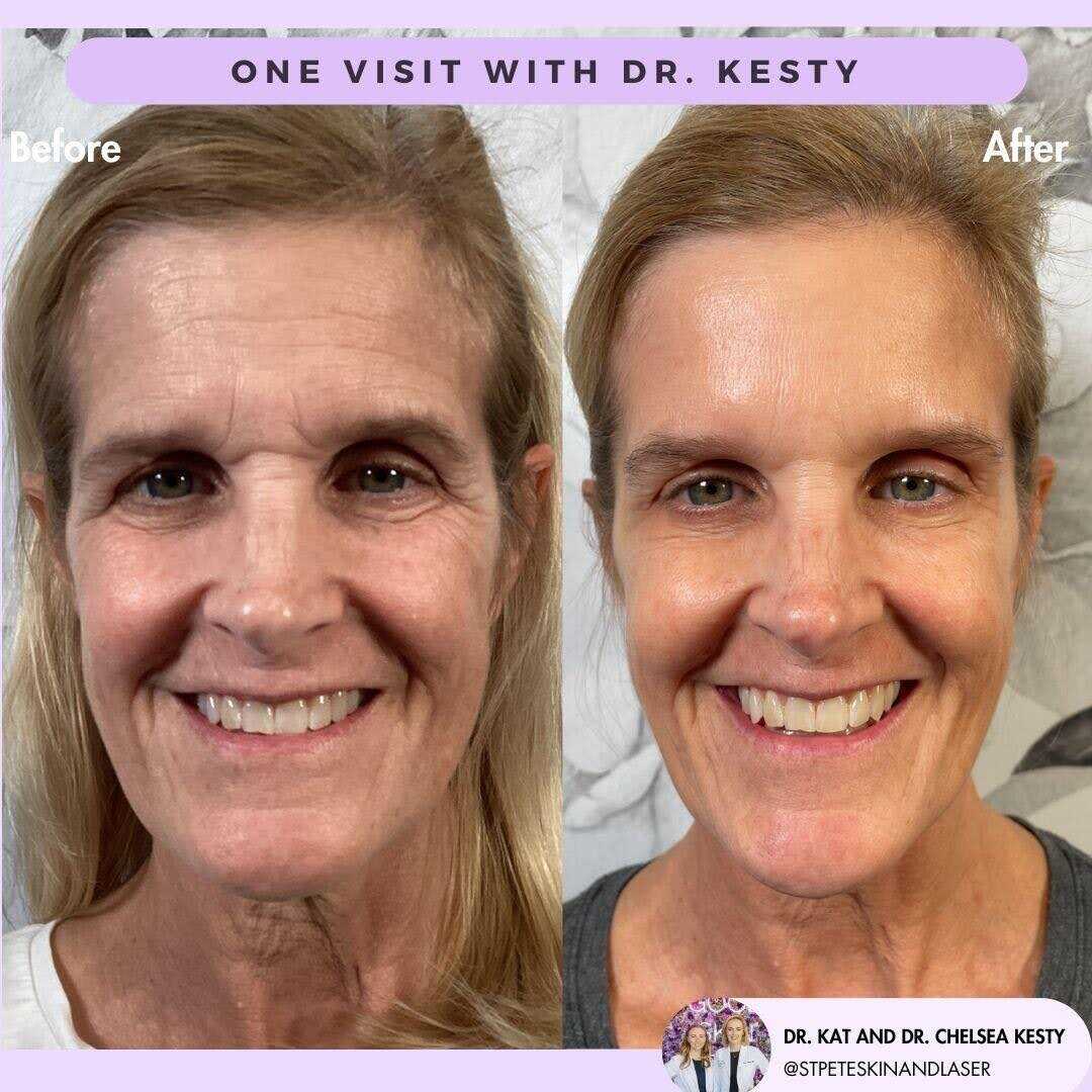 Dramatic wrinkle reduction results from laser treatment
