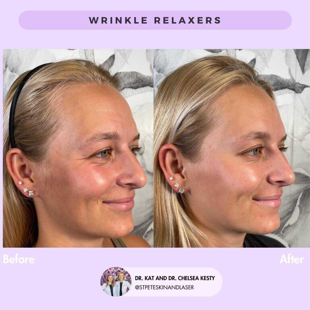 Complete facial rejuvenation with laser treatment