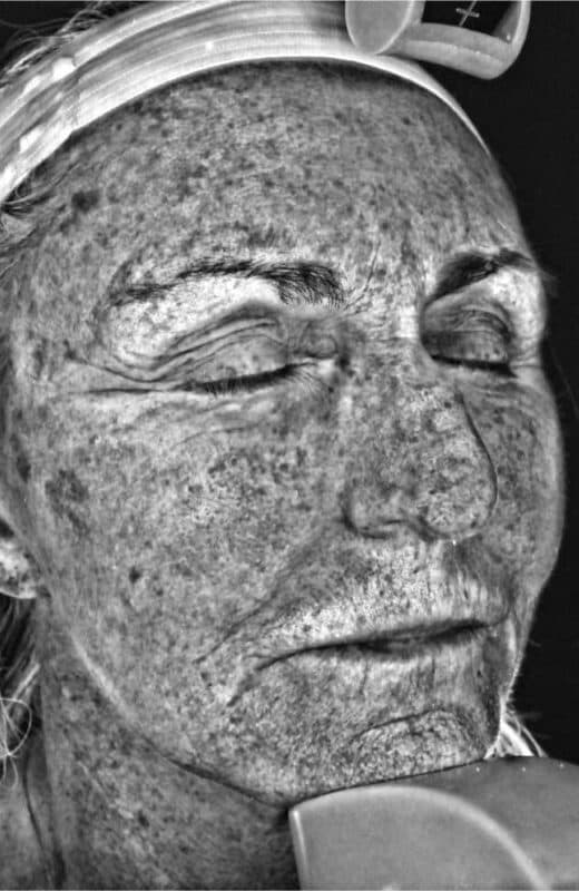 After rosacea treatment