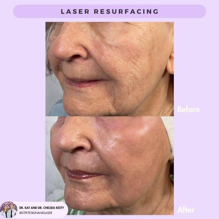 Ablative laser skin treatment performed by dermatologist for wrinkle and sun damage removal