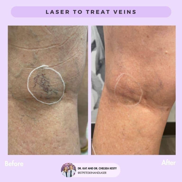 Vascular laser treatment for broken blood vessels and facial redness