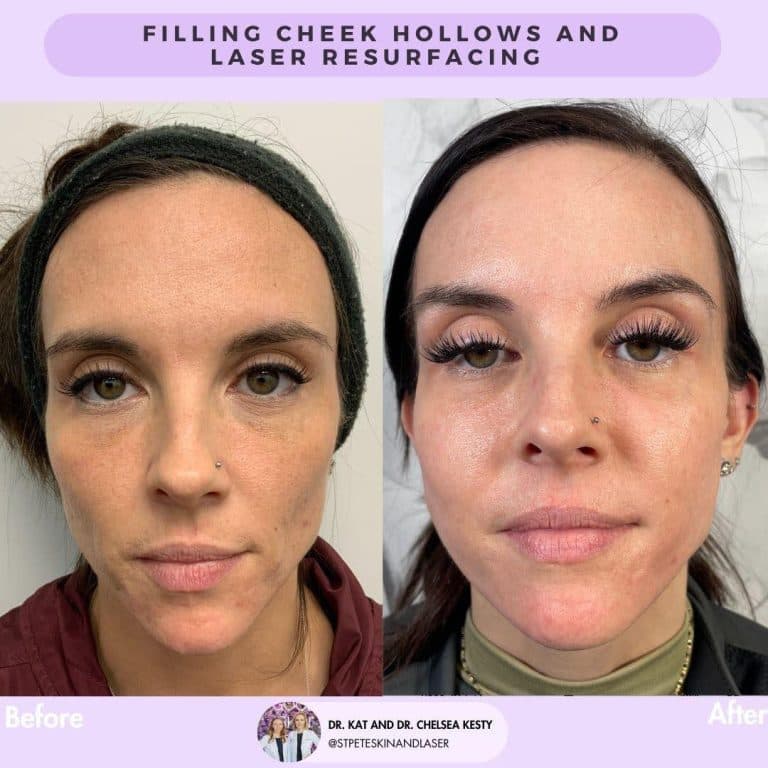 Dermal filler treatment