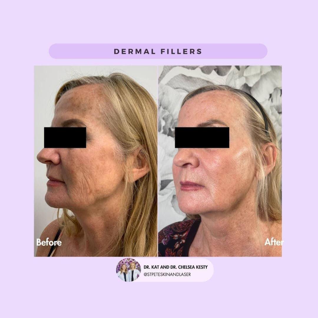 Facial volume loss before and after results