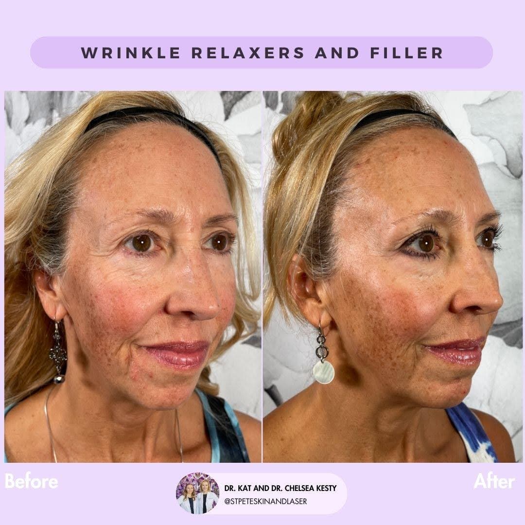 Dermal filler results