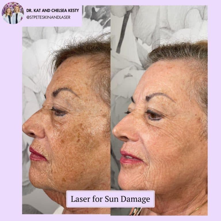 IPL intense pulsed light treatment for sun damage and pigmentation correction