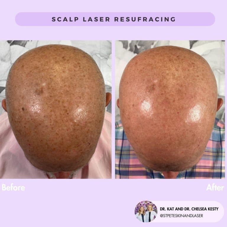 Non-ablative laser treatment for collagen stimulation and skin texture improvement