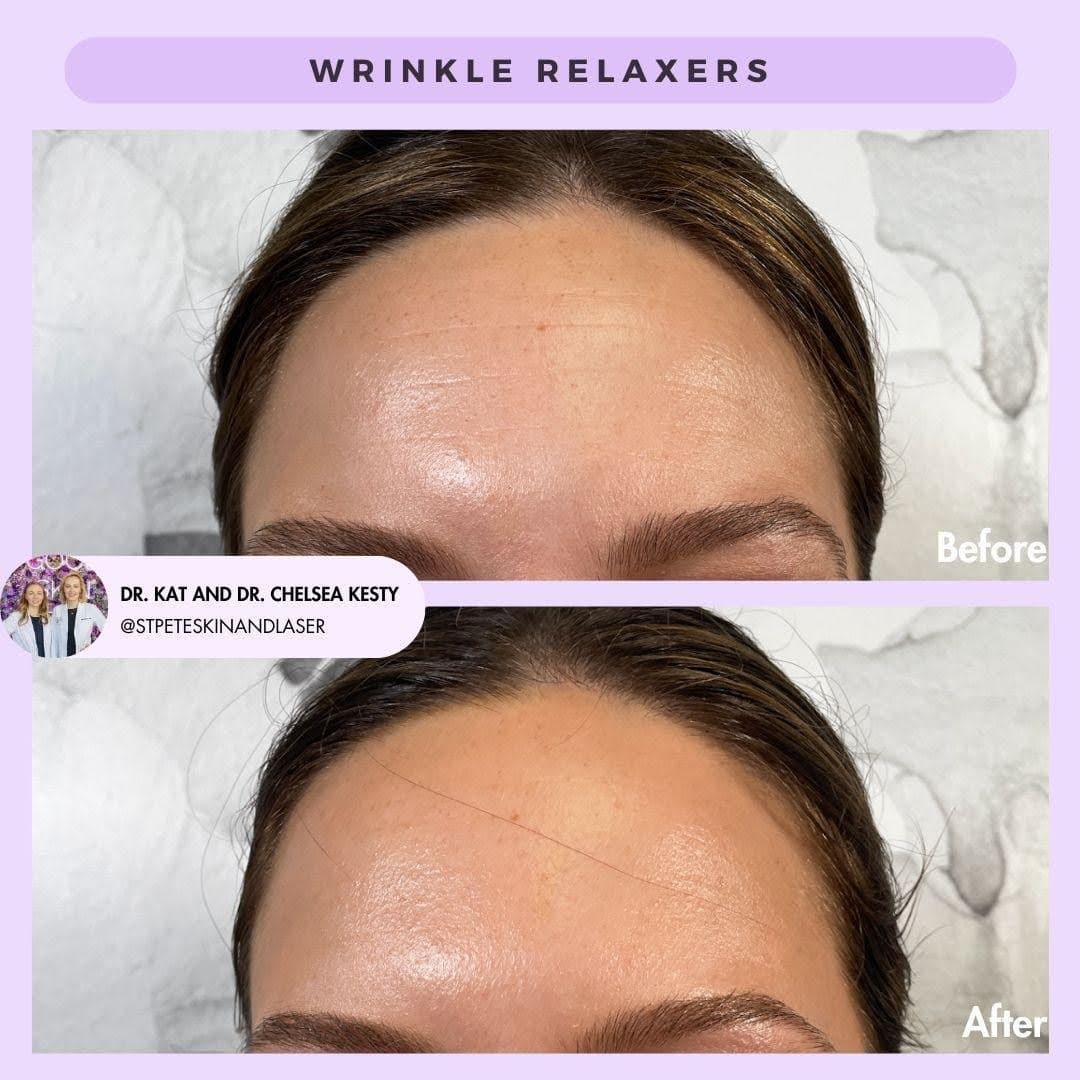 Wrinkle Relaxer Results After