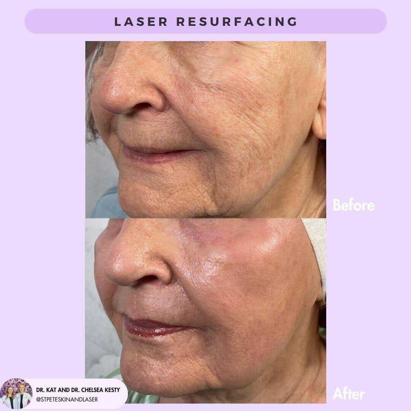 Ablative laser treatment results