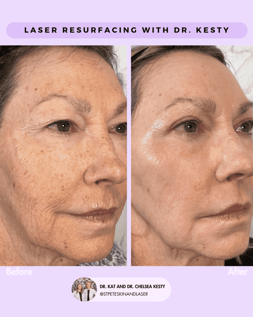 Before and after laser treatment