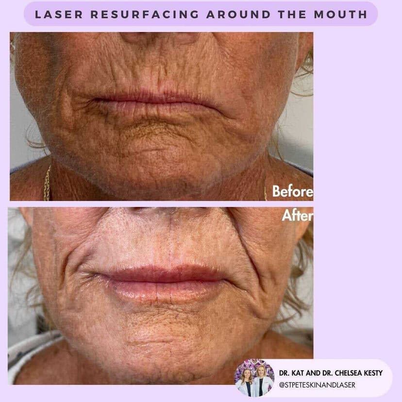 Skin rejuvenation results