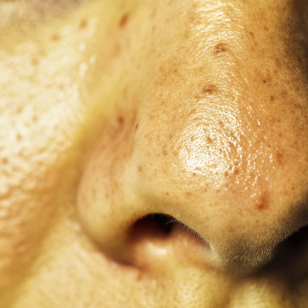 Enlarged Pores treatment approach