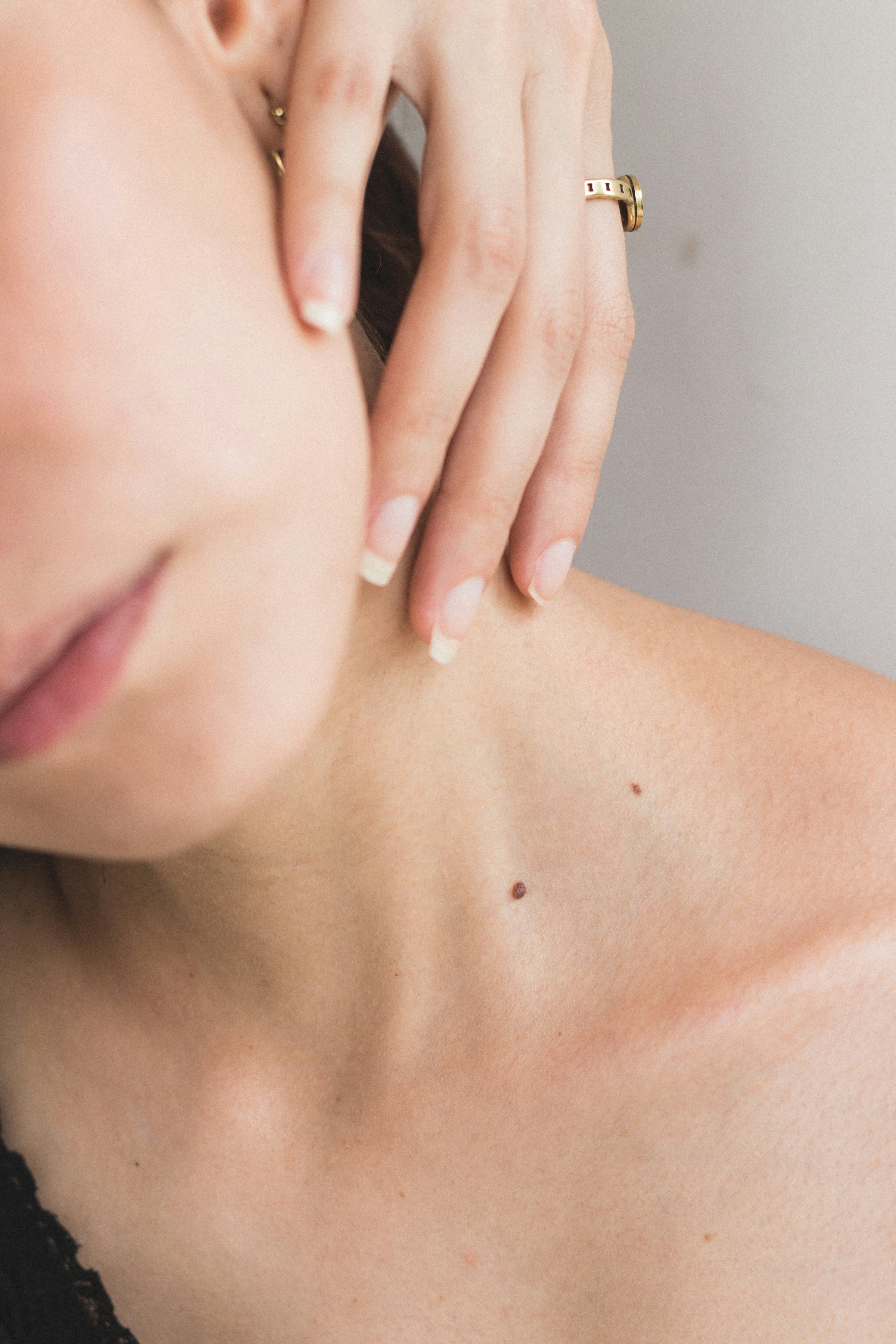Acne scars FAQ with Dr Kesty