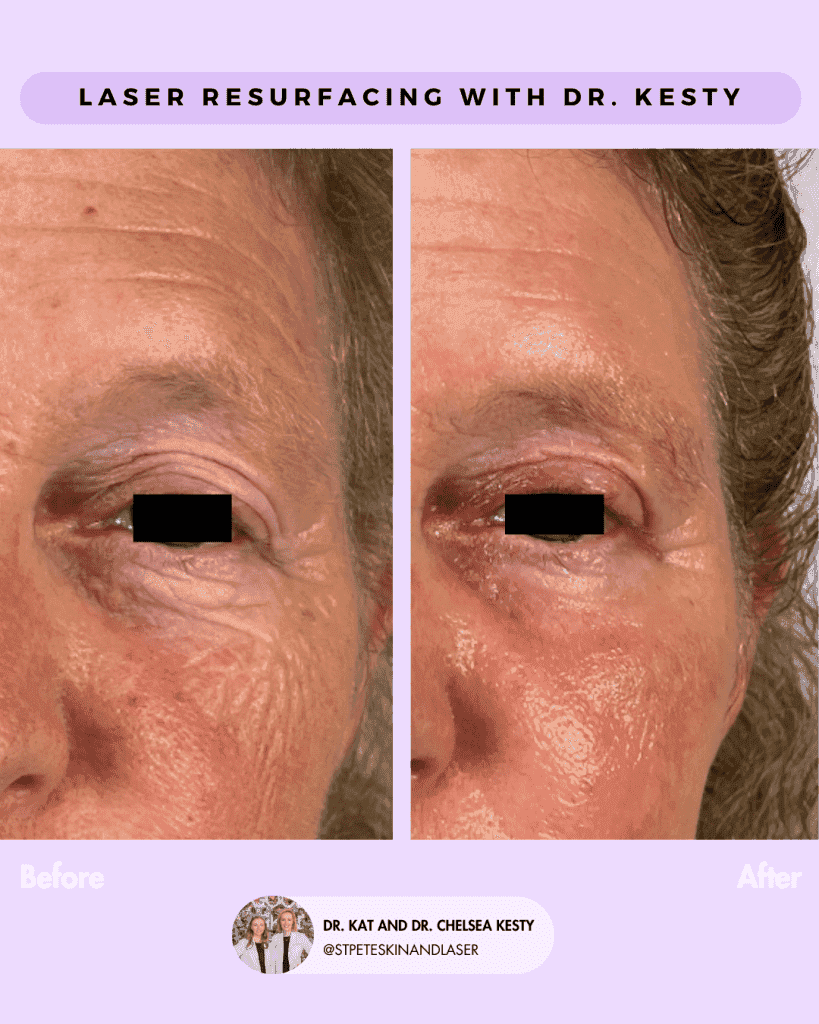 Laser Resurfacing Results treatment result