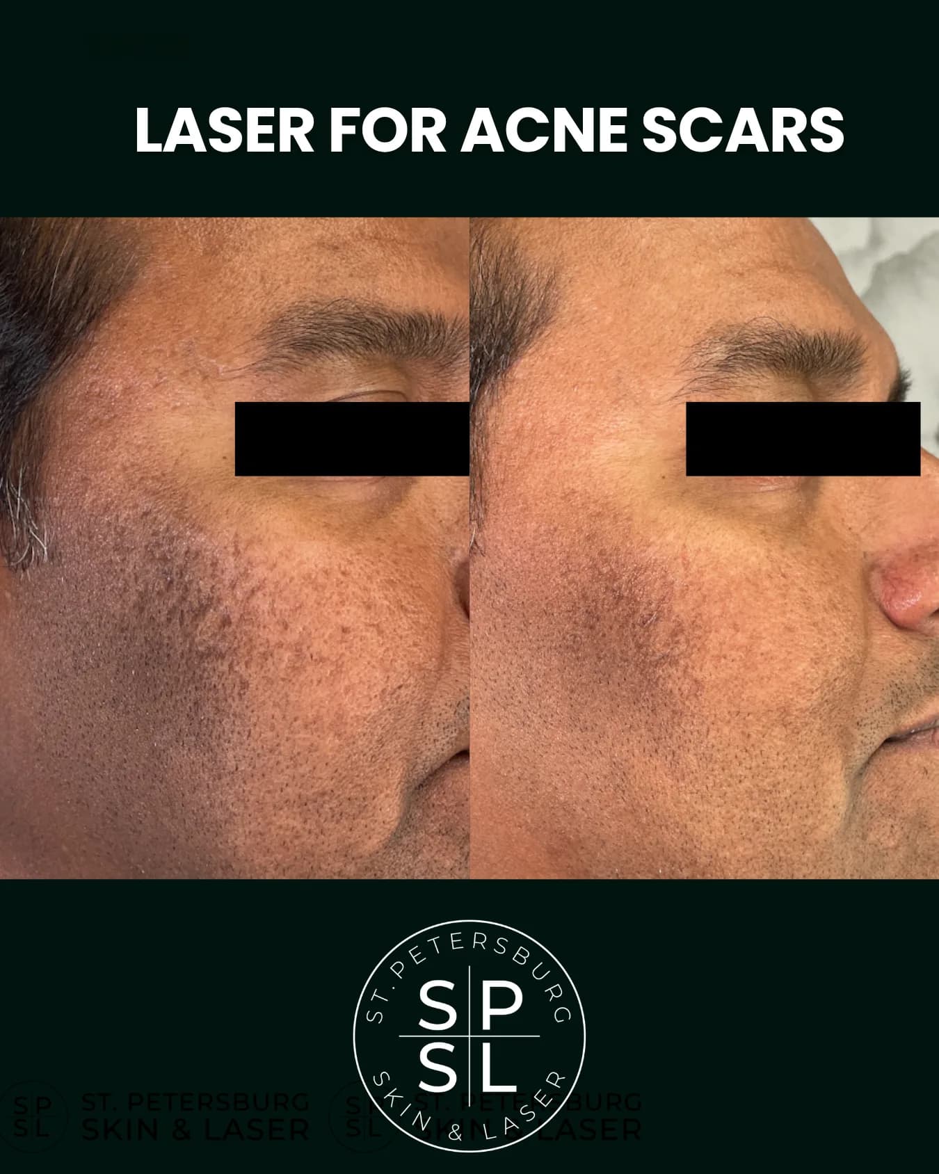 Acne Scar Laser before and after results