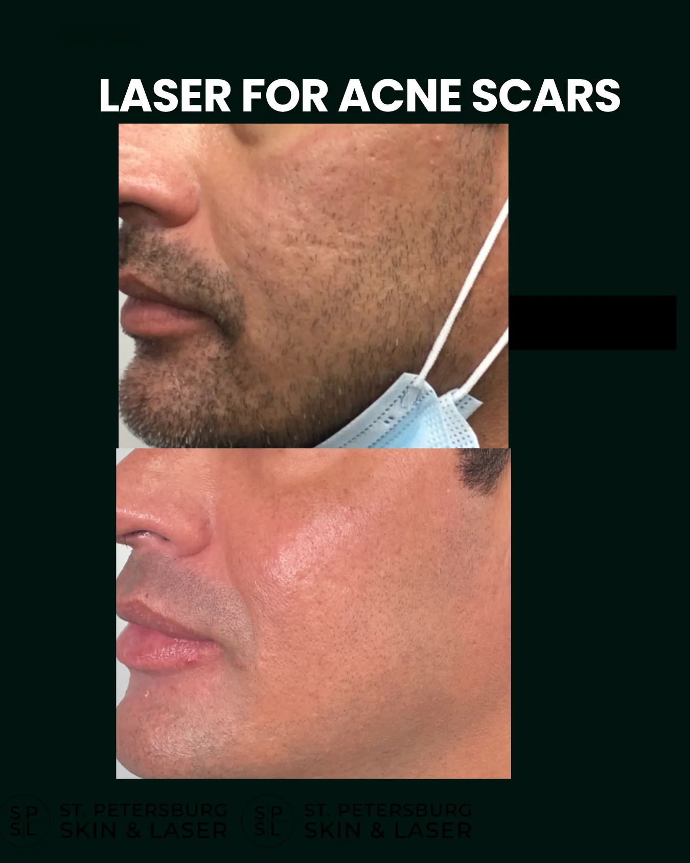 Acne Scar Laser before and after results