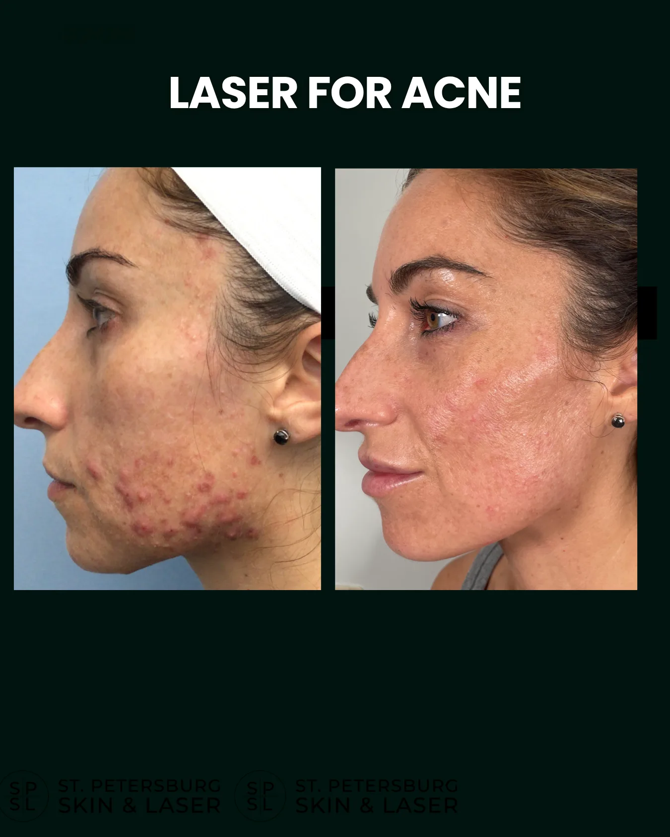Acne Scar Laser before and after results