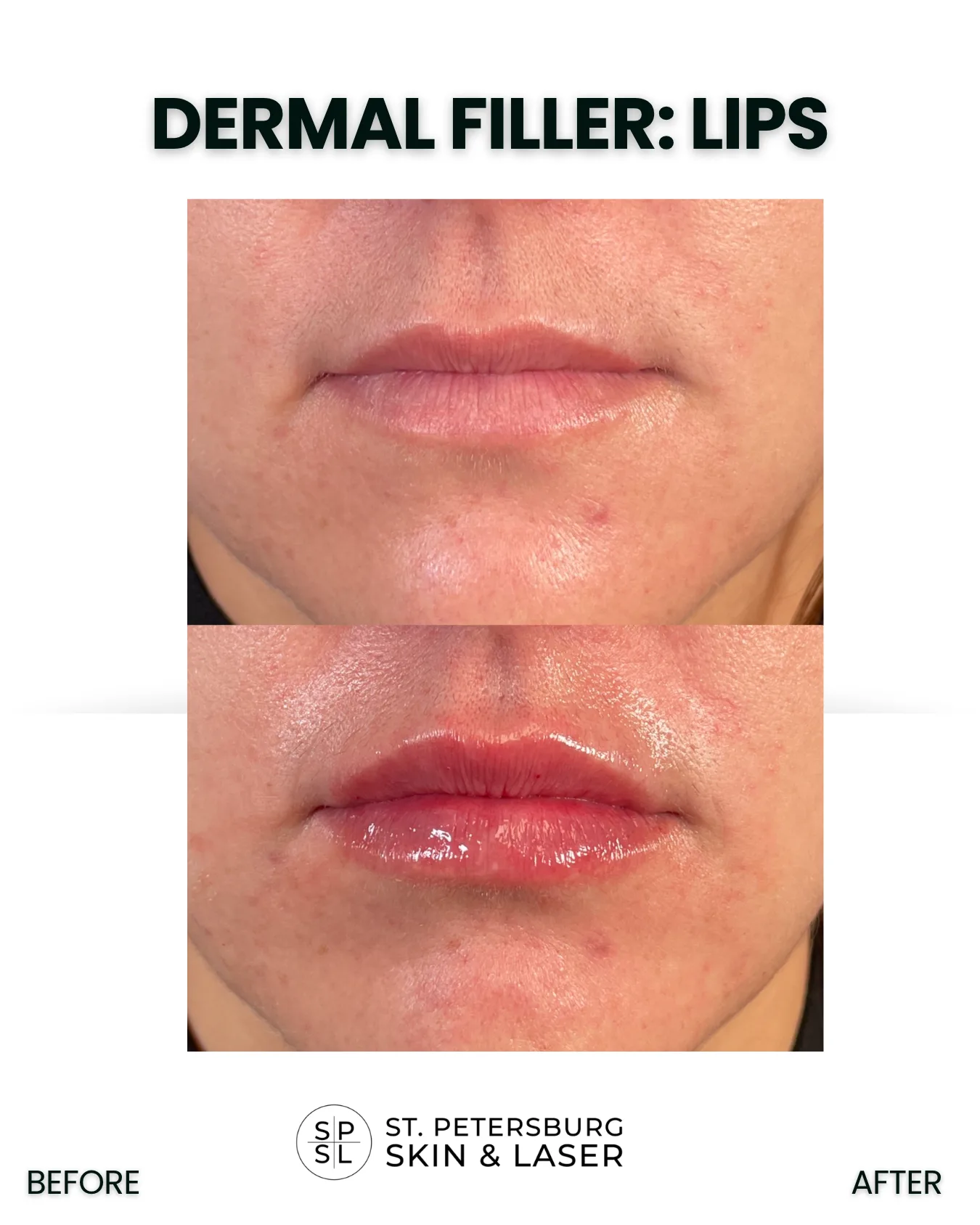 Dermal Fillers before and after results