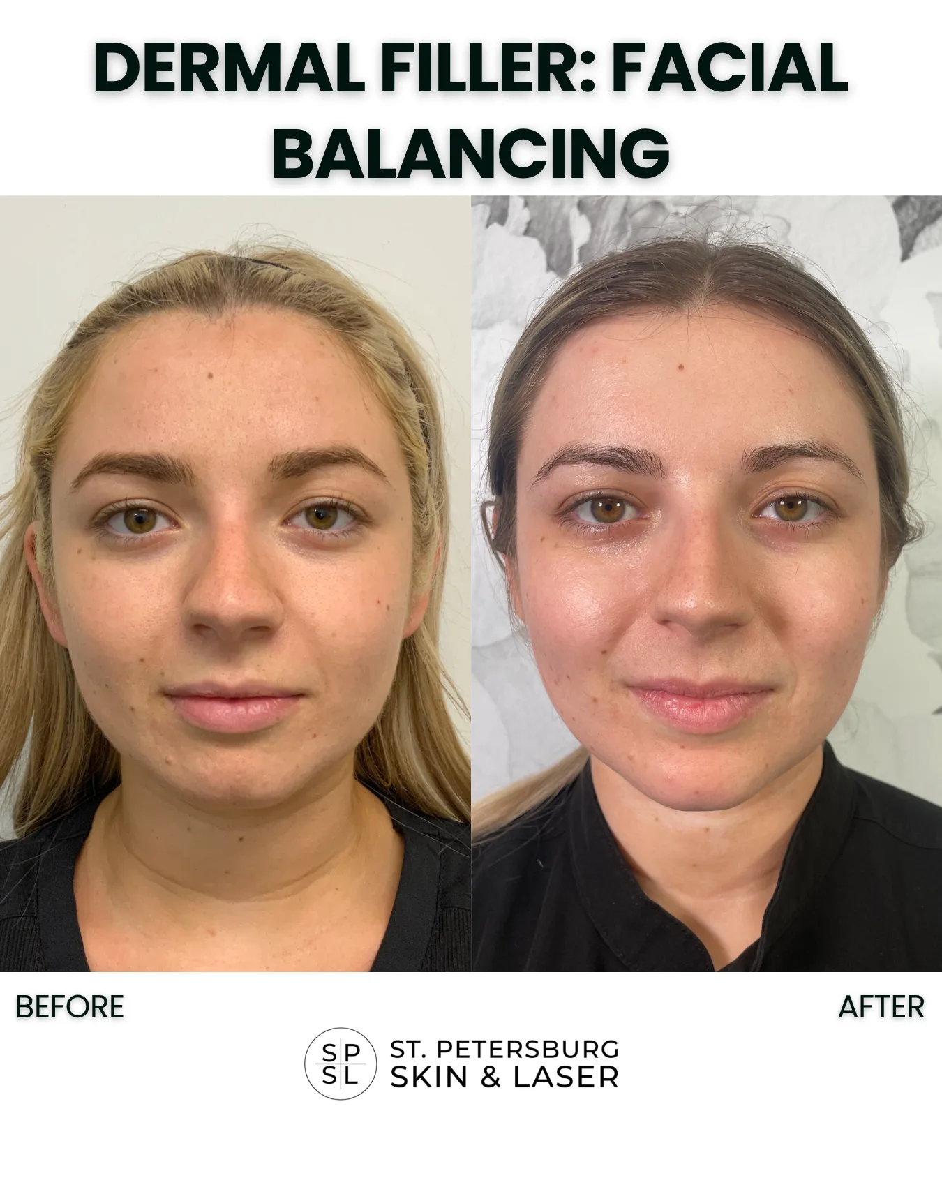 Dermal Fillers before and after results