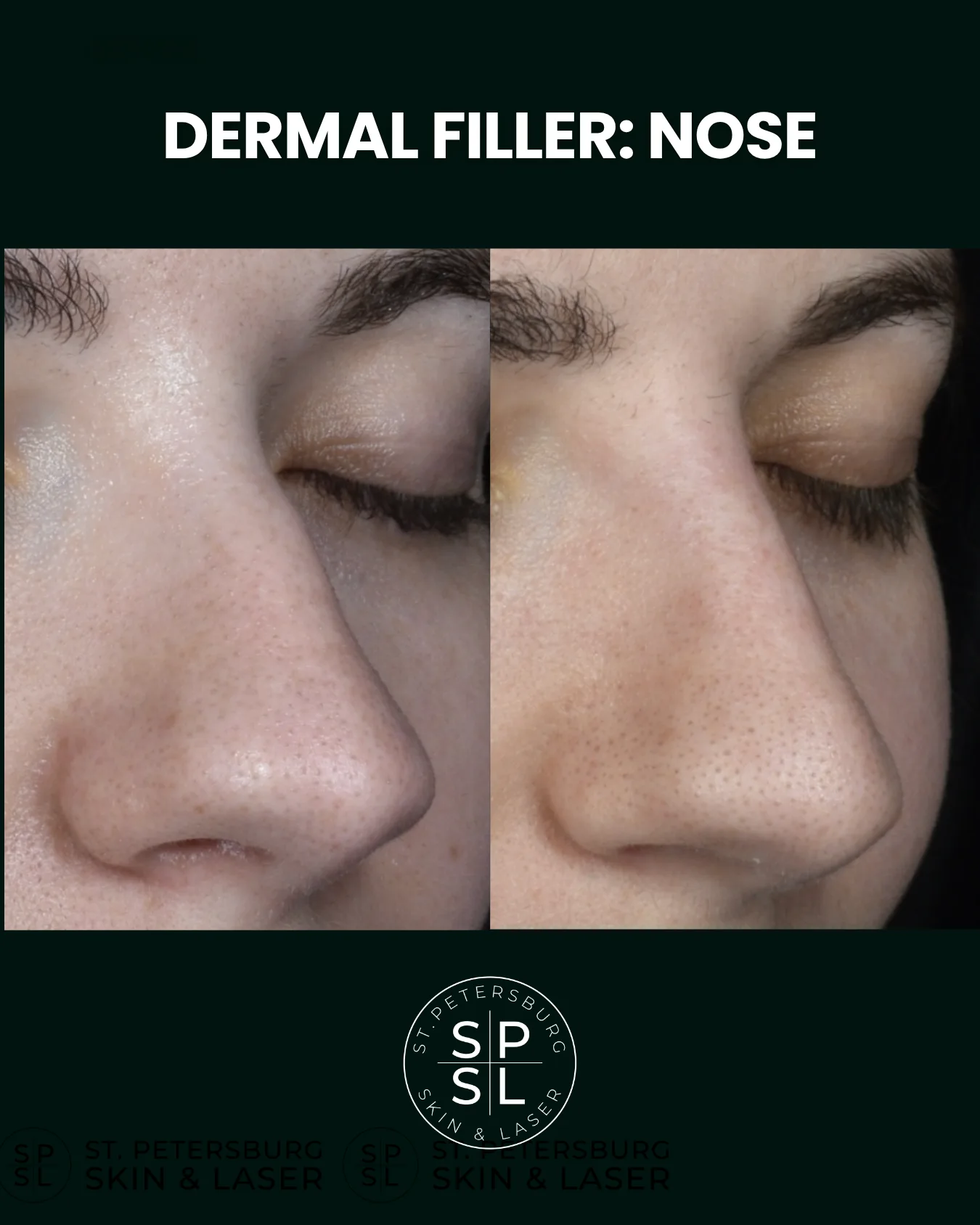 Dermal Fillers before and after results