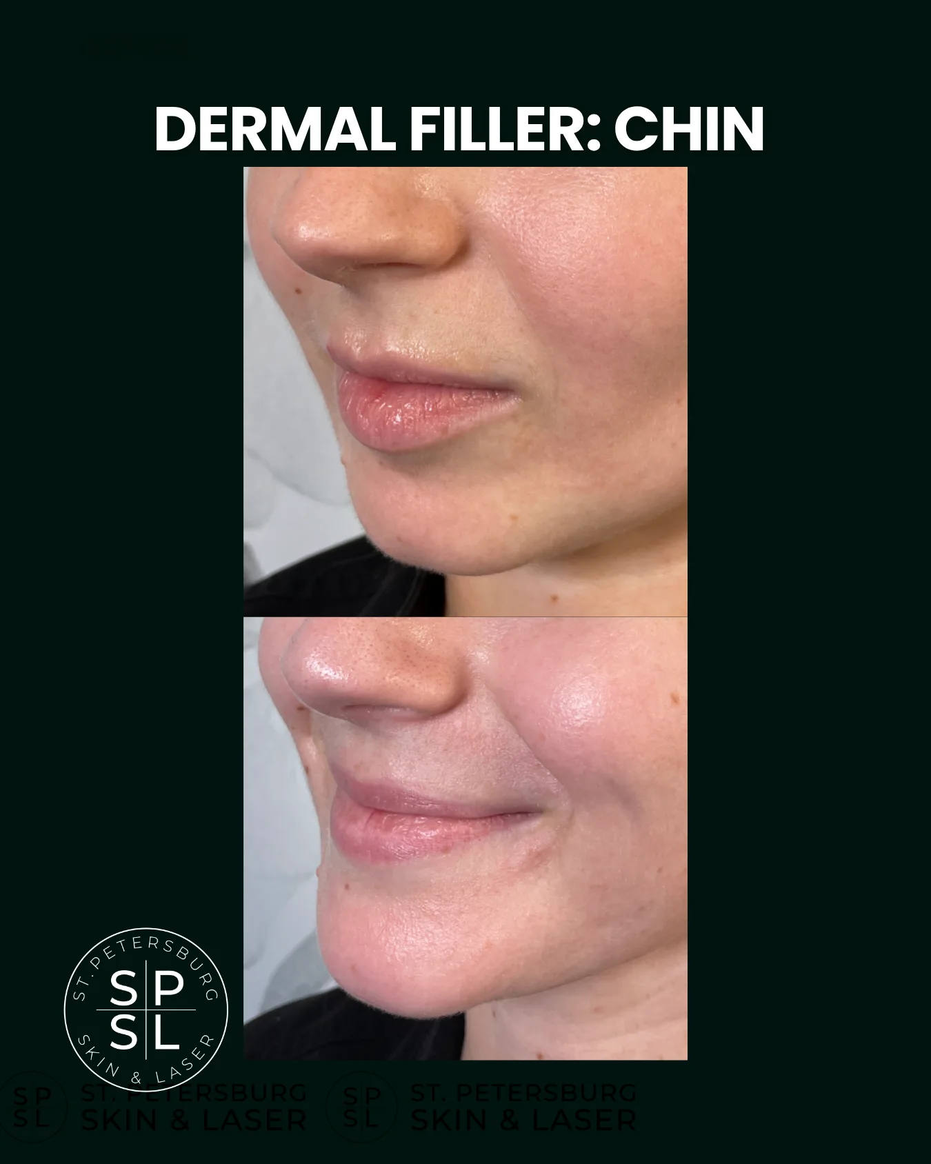 Dermal Fillers before and after results