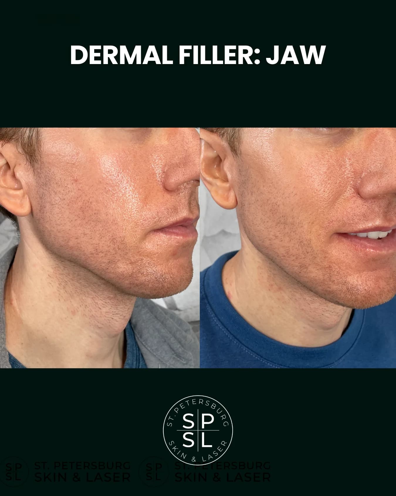Dermal Fillers before and after results