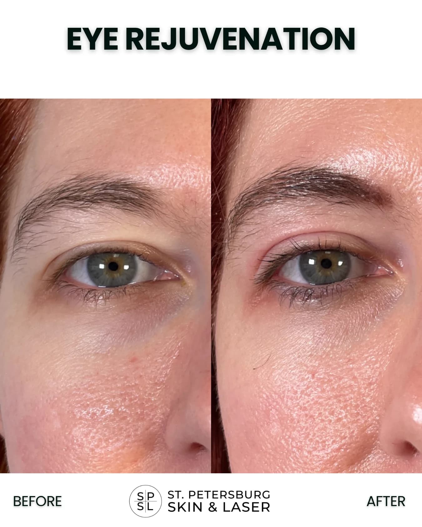 Eye Rejuvenation before and after results