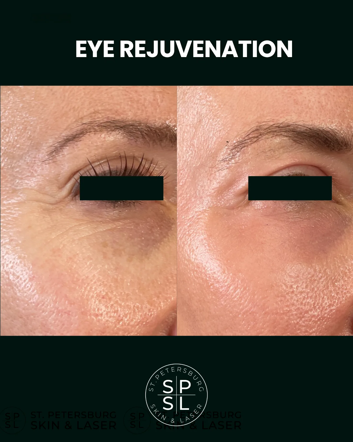 Eye Rejuvenation before and after results