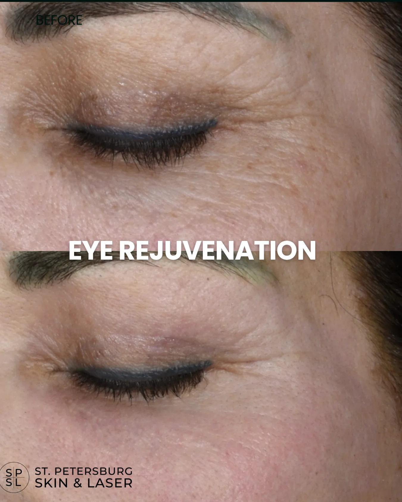 Eye Rejuvenation before and after results