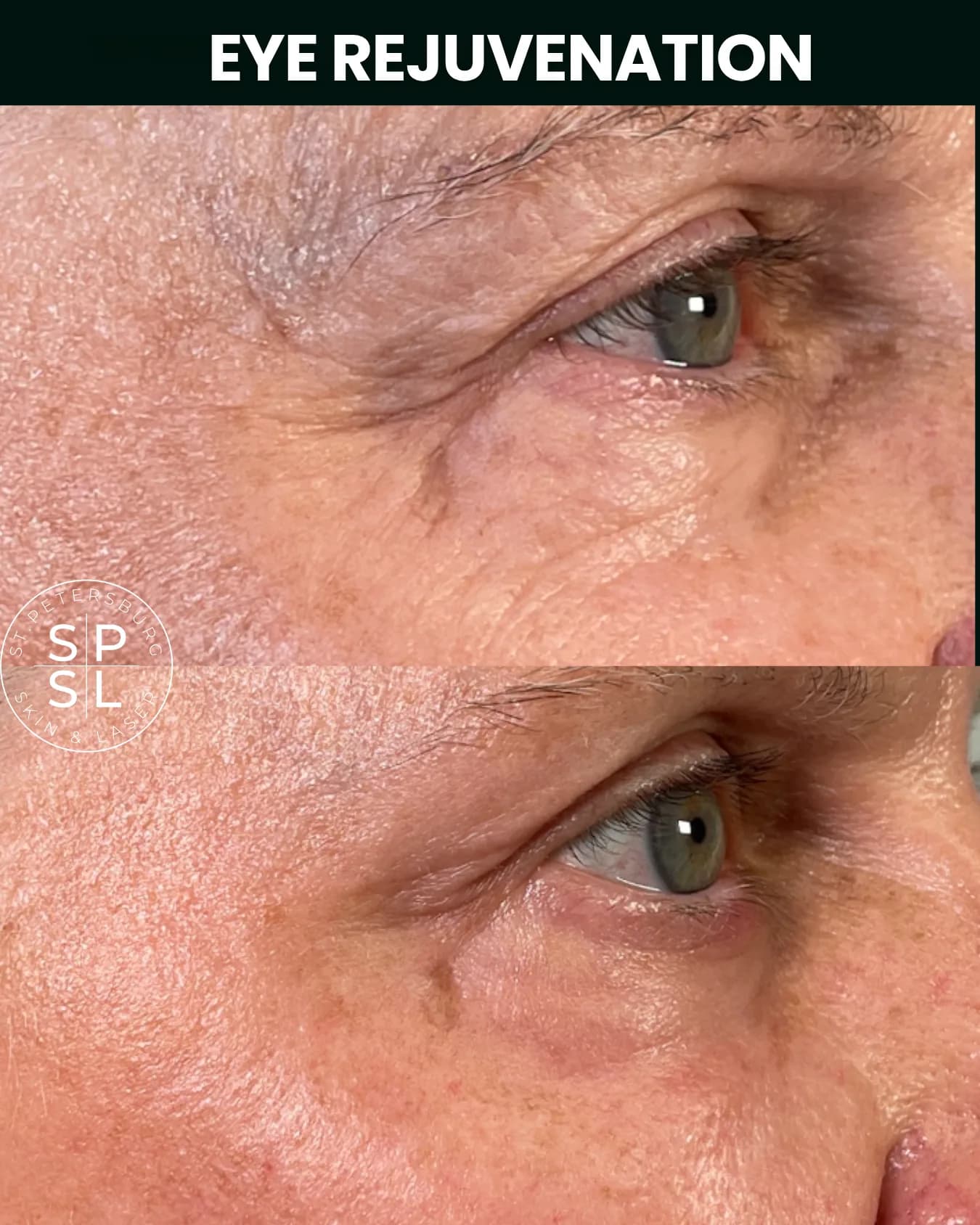 Eye Rejuvenation before and after results