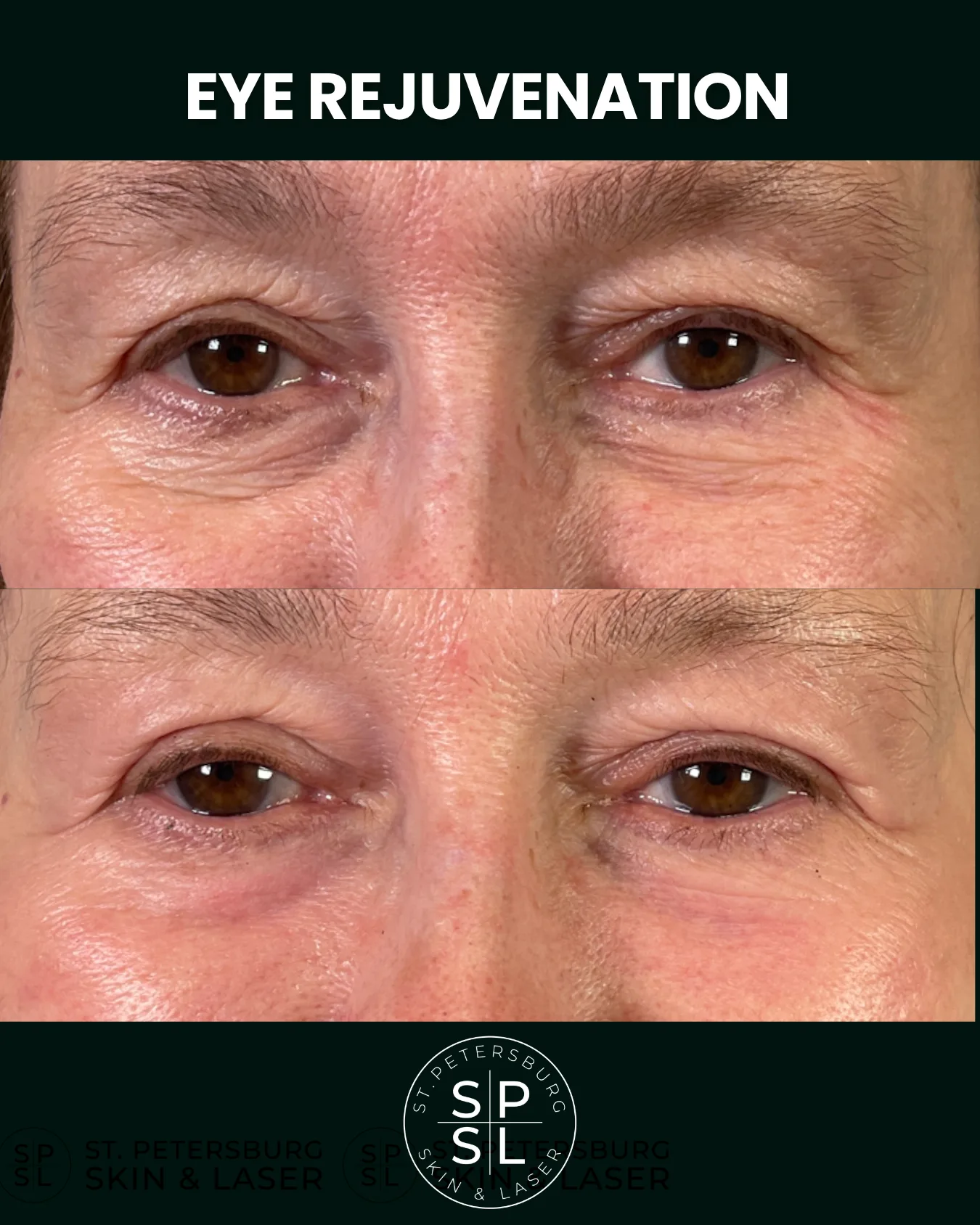 Eye Rejuvenation before and after results