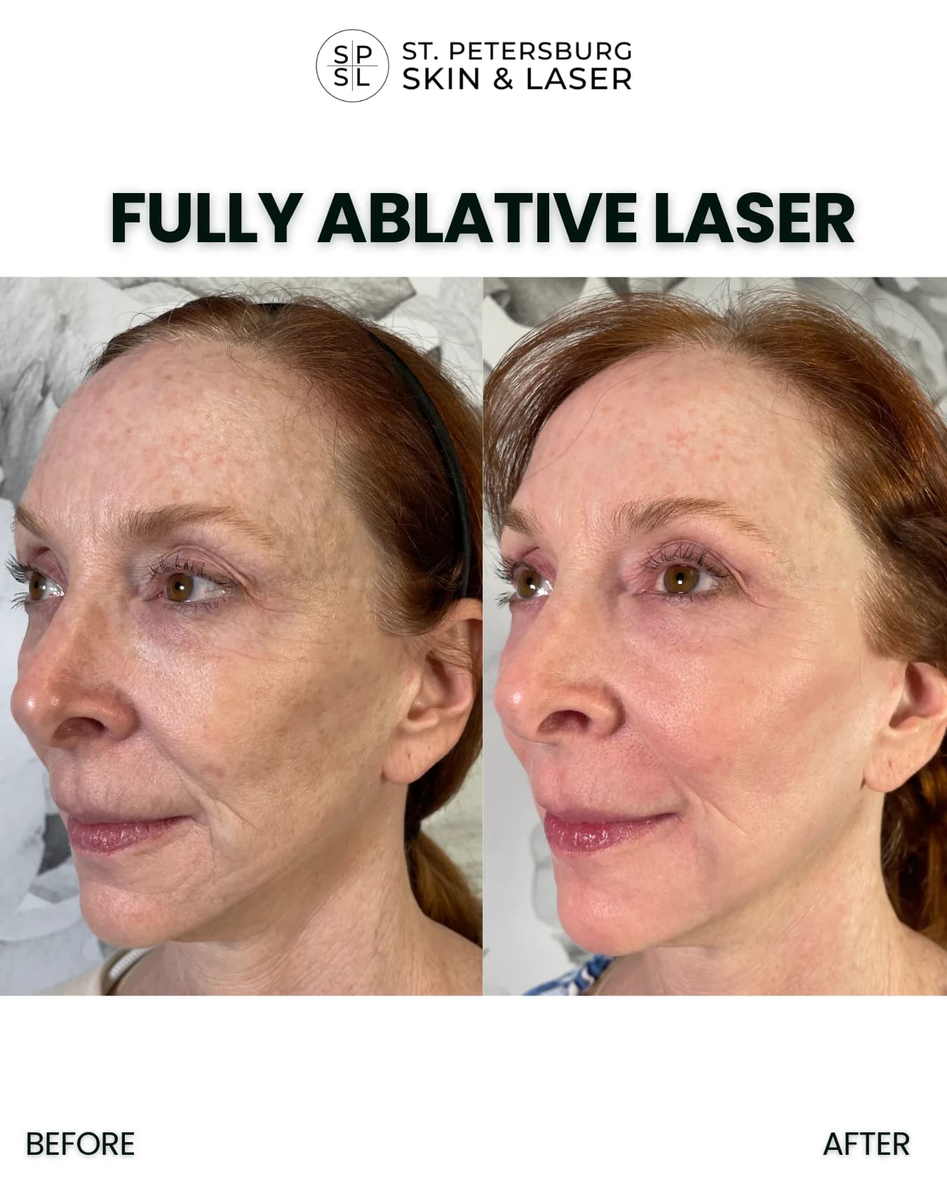 Fully Ablative Laser before and after results