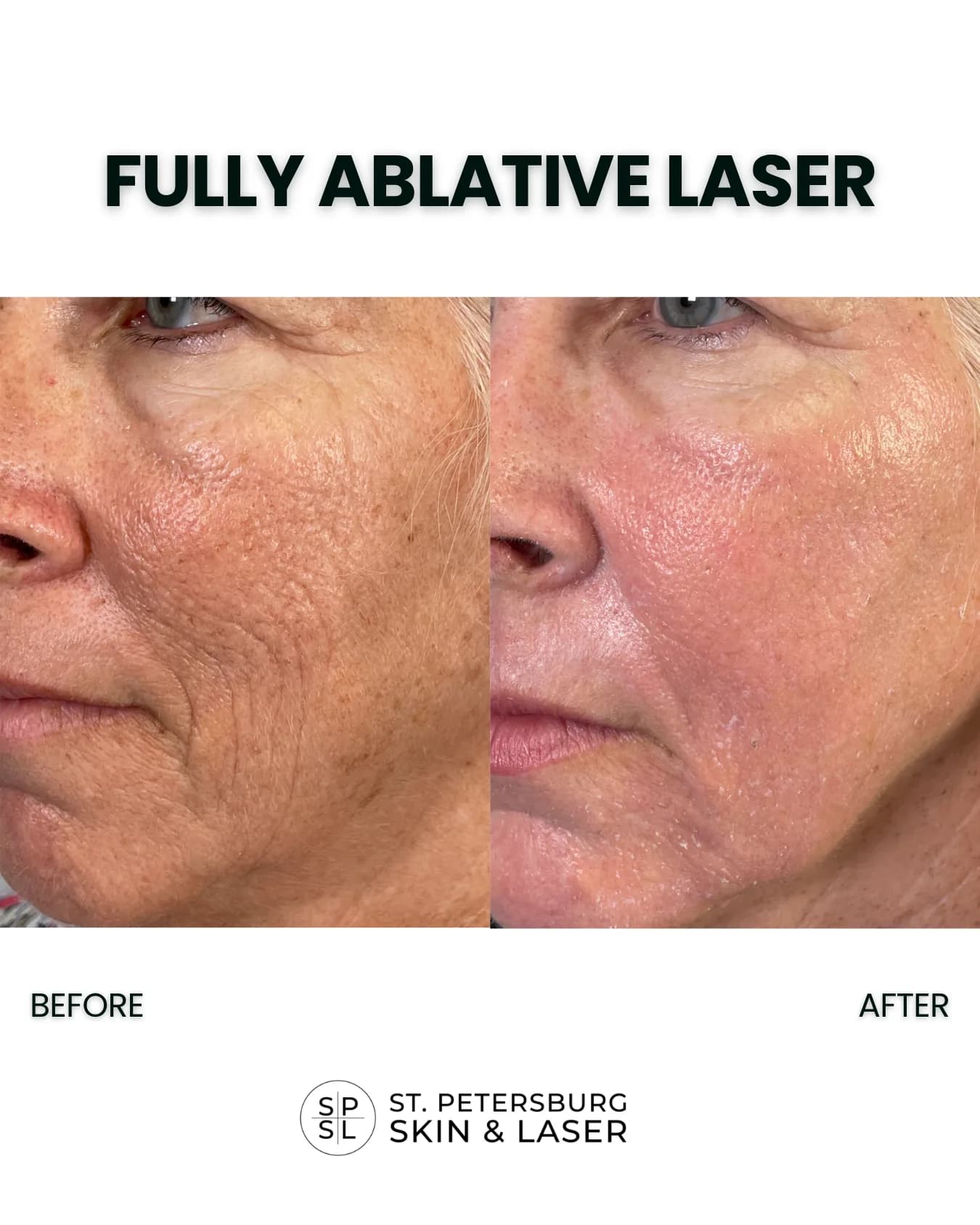 Fully Ablative Laser before and after results